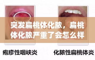 突发扁桃体化脓，扁桃体化脓严重了会怎么样了 