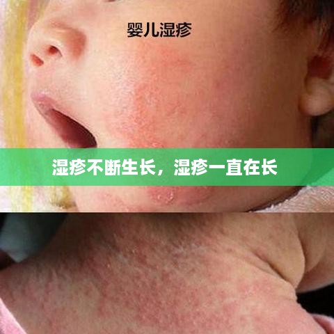 湿疹不断生长，湿疹一直在长 