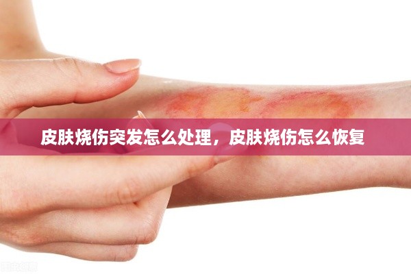皮肤烧伤突发怎么处理，皮肤烧伤怎么恢复 